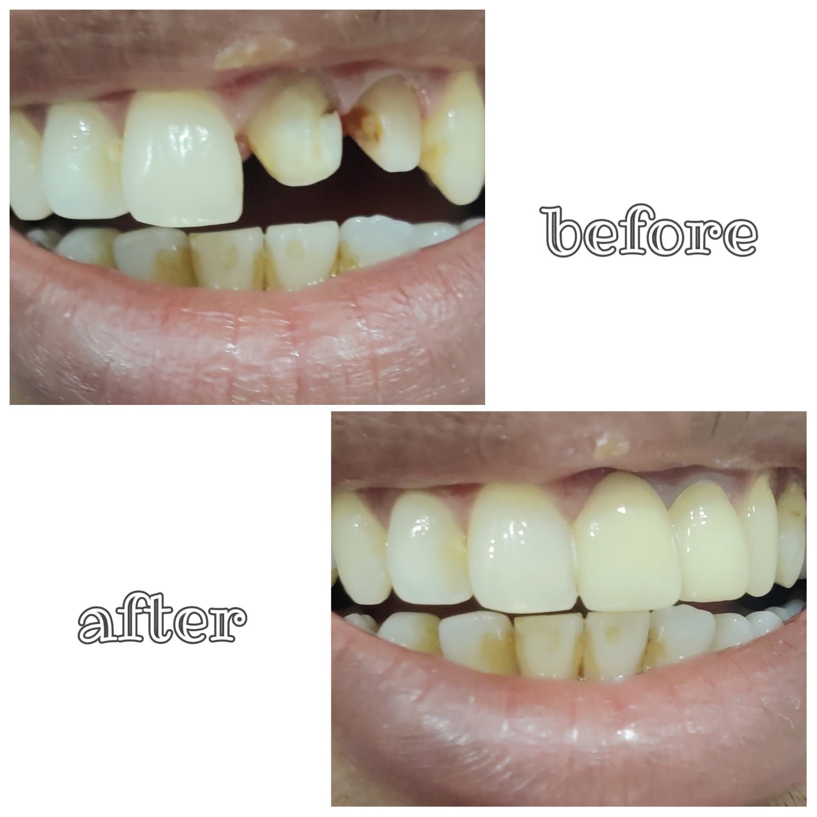 before and after teeth whitening